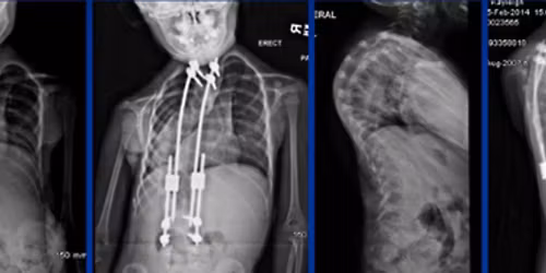 Paediatric Spine Deformity: Overview and Non-Fusion Techniques