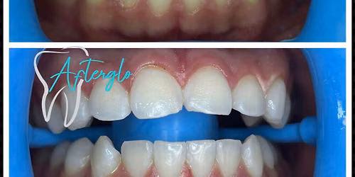 Sunday sale. Save $95 on teeth whitening 