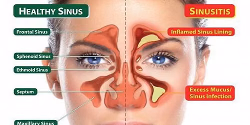 Ayurvedic Sinus Treatment; Therapeutic Nasya, Sans, Steam and Pranayama In Person or Online