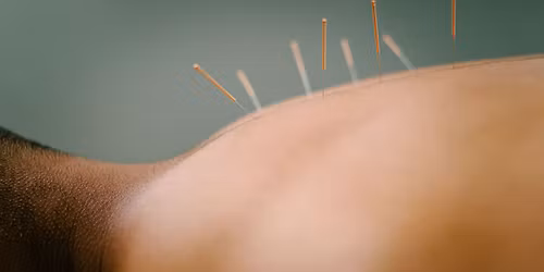 Community Acupuncture 