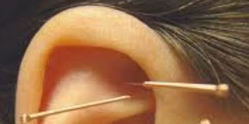 5NP Auricular Acupuncture Free Student Clinic