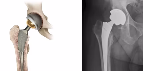 What it takes to be Hip (or Knee!):  The development of joint replacement