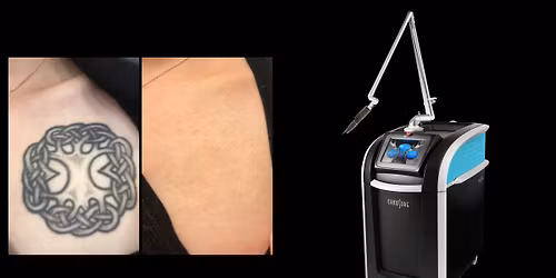 2026 TATTOO REMOVAL REFERRAL PROGRAM!