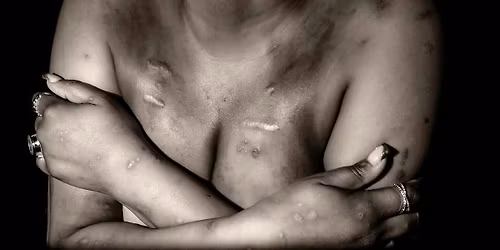 Scar Stories: A Visual Testimony of Sickle Cell Warriors  Exhibit Opening