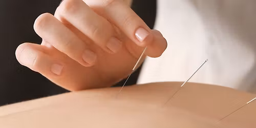 Dry Needling\/Medical Acupuncture Course (Level 1)