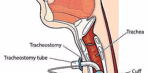 Trache CEN study day 2026: Tracheostomy Across Pathways