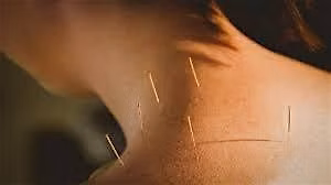 Community Acupuncture - 2pm