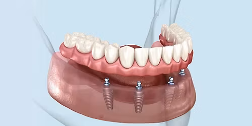 Implant-Supported Fixed Detachable\/Hybrid Restorations