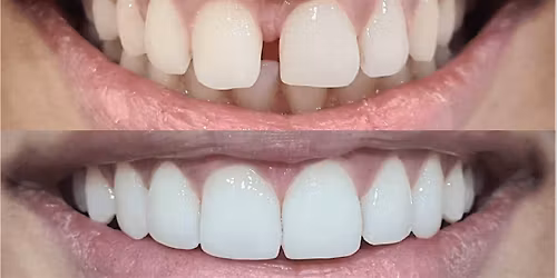 Study Circle - Invisalign Bond Up, Whitening, & Edge Bonding