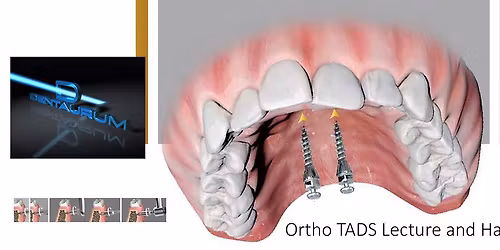 Orthodontic Temporary Anchorage Devices (TADS):  Lecture and Hands-On Workshop