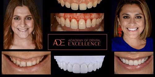 Precision Crown Lengthening for the Modern General Dentist (Perth)