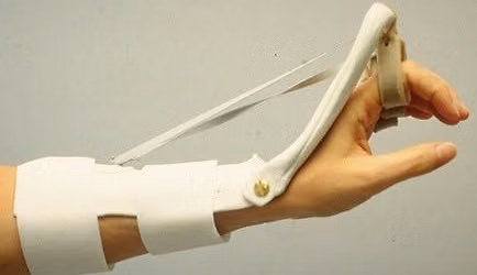 The Art of Orthosis Fabrication: Static, Dynamic and Static Progressive Techniques-Hand, Wrist
