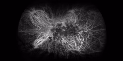 2026 Retina Update for the Optometrist