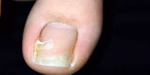 2026\u5e744\/11\u571f\u2605\u6a2a\u6d5c\u958b\u50ac\u2605\u8db3\u722a\u306b\u7279\u5316\u3057\u305f\u4eba\u5de5\u722a\u5f62\u6210\u30bb\u30df\u30ca\u30fc\u30fb\u72ec\u30de\u30b7\u30f3\u30d5\u30c3\u30c8\u30b1\u30a2\u5b9f\u7fd2\u3082\u542b\u307f\u4eba\u5de5\u722a\u5f62\u6210\u30fb\u6b20\u640d\u4fee\u5fa9\u30fb\u722a\u80b2\u88dc\u6b63\u3092\u4e00\u6c17\u306b6\u7a2e\u985e\u5b66\u3079\u308b\u6700\u5f37\u306a\u4eba\u5de5\u722a\u6f14\u7fd2\u30bb\u30df\u30ca\u30fc