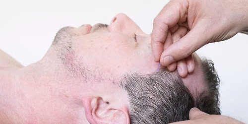 Medical Acupuncture - Level 1 - September 12-13 Edinburgh