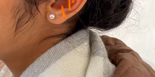 Menopause Acupuncture Clinic