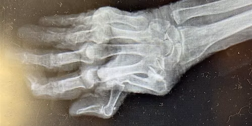 Pain Science in Hand Therapy: Modern strategies for Clinical Practice