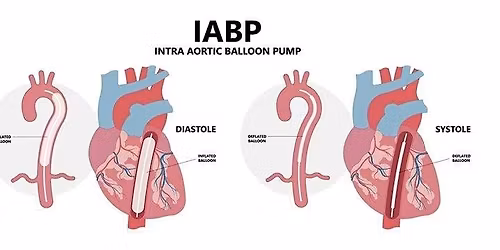 Intra Aortic Balloon Pump