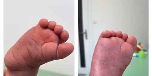 "Tr\u00f3jwymiarowa manualna terapia wad st\u00f3p u dzieci na podstawach neurofizjologicznych wg Barbary Zuku