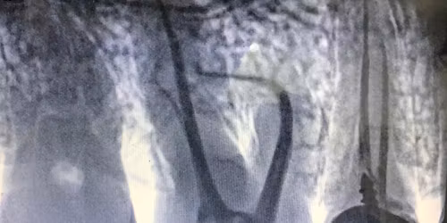 OralHealthmanagement #7-7=14 creramic teeth placed#oral health#dr. Alka khade