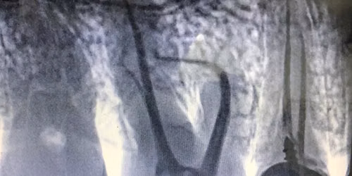 OralHealthmanagement #7-7=14 creramic teeth placed#oral health#dr. Alka khade