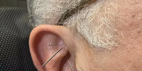 Community Acupuncture- Acudetox