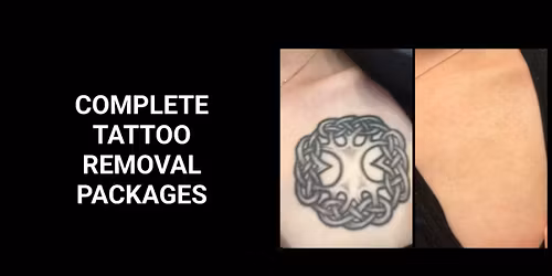 20 Tattoo Removal Packages Available - $700 Cash Per Package!