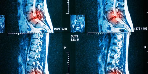 Disc Restoration Workshop \u2014 A Spinal Surgery Alternative