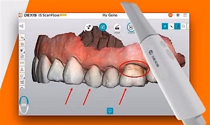 Enhance Patient Communication with 3D IOS Scans & AI Software