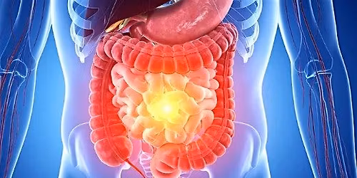 Colon Cancer Screening Lecture