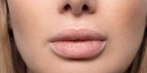 BOTOX SACRAMENTO | AESTHETIC INJECTOR | ROSEVILLE | LIP FILLERS