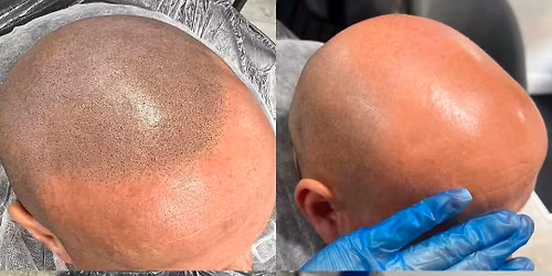 SMP- Scalp Micropigmentation, Laser Tattoo removal,Hair Removal, Face Carbon