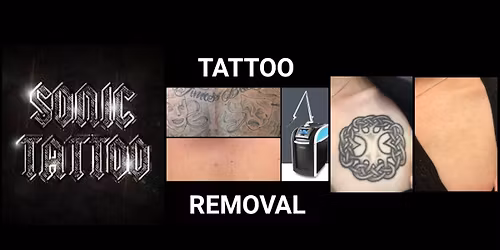 20 Tattoo Removal Packages - $700 Cash Per Package!