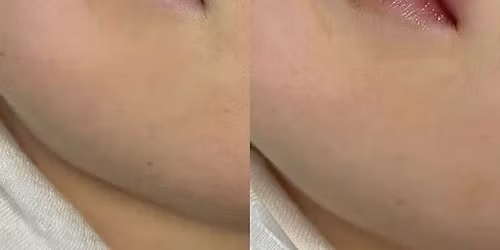 BOTOX SACRAMENTO | AESTHETIC INJECTOR | ROSEVILLE | LIP FILLERS