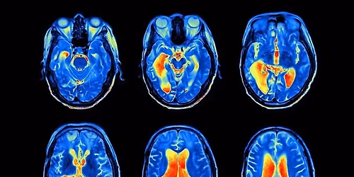 Replacement of Animals in Research (RoAR) - Neurological Disease Modelling