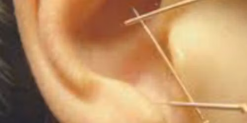 5NP Auricular Acupuncture Clinic w\/ Stina