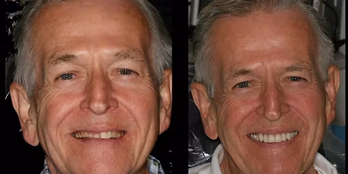 NOVEMBER 2025 Denture Bootcamp