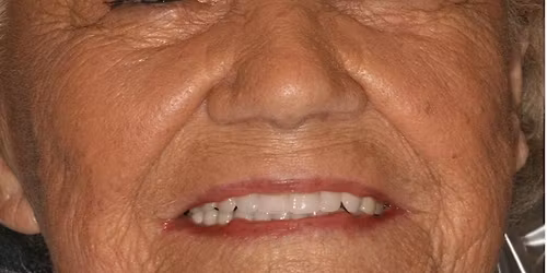 Removable Partial Dentures: Design and Fabrication (12 CE Credits)