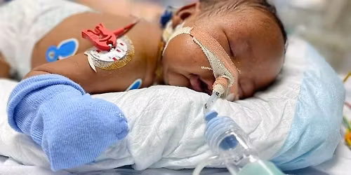 Heart Surgery Camp for Children in Imphal, Manipur