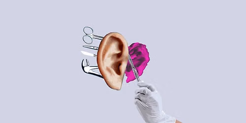 Ear Transplant - Surgery #1