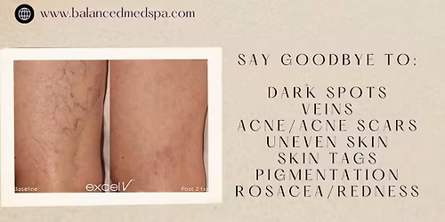 No More Cover Ups: Excel V+ Laser Event