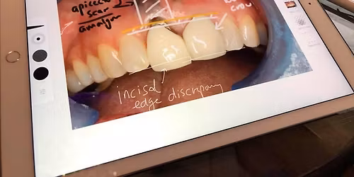 Implant Overdentures