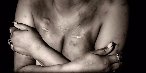 Scar Stories: A Visual Testimony of Sickle Cell Wariors Exhibit