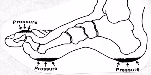 Temadag om s\u00e5rbehandling og fods\u00e5r hos mennesker med diabetes