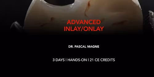 ADVANCED INLAY\/ONLAY