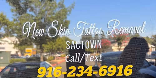 New Skin Tattoo Removal SacTown