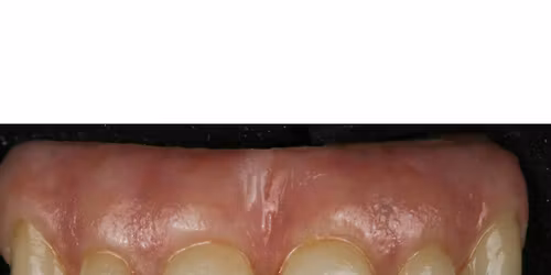 MiYo and Monolithic Zirconia Hybrids