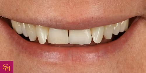 Reclaim Your Smile & Confidence : Implant Open Day at Sale Dental Care