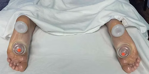 History & Intro to Cupping Therapy