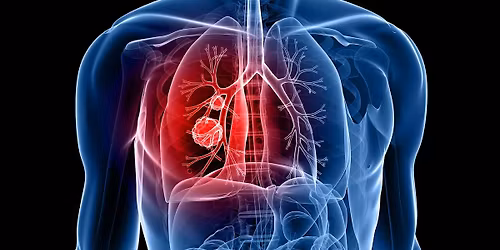 Lung Cancer Study Day